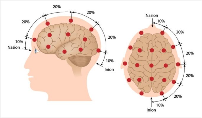 Electroencephalogram Eeg Neurocare